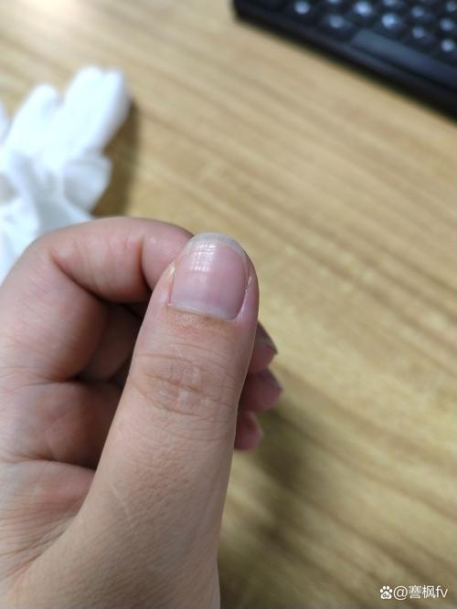 指甲出现横纹是病吗?这 3 种情况需要及时检查