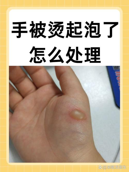 烫伤起水泡要不要挑破？不同程度处理步骤
