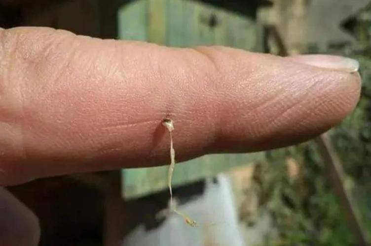 蜂蛰毒刺拔除工具?信用卡边缘刮除
