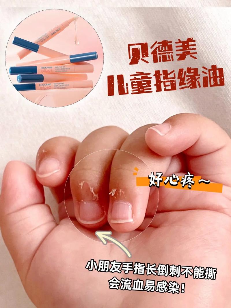婴儿指甲长倒刺？涂抹「凡士林」保湿