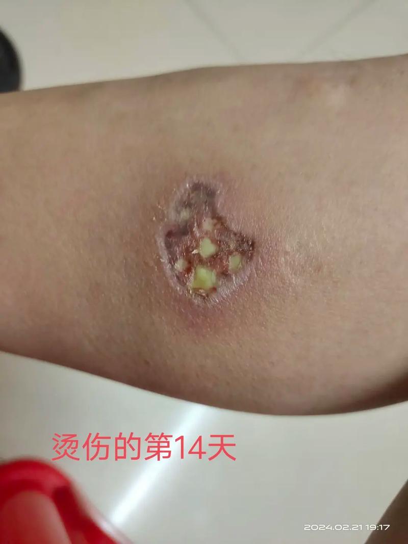 烫伤疤痕预防要点？愈合期防晒