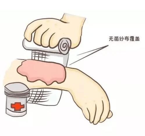 烫伤瘢痕挛缩预防？压力衣使用