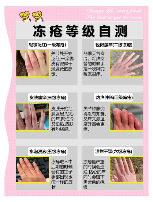 如何预防冻疮？冬季必备小技巧